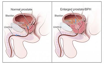 Tumore della prostata: migliorano le prospettive con la pre-chemioterapia orale di ultima generazione